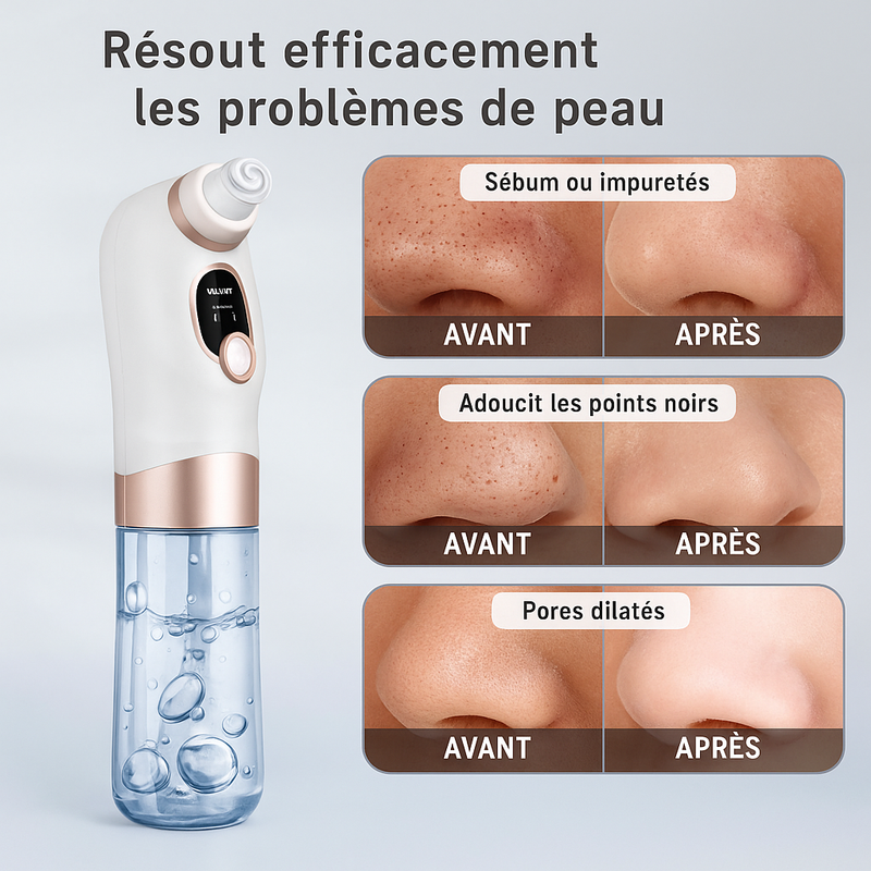 SoftSkin –Appareil de dermabrasion et nettoyage du visage